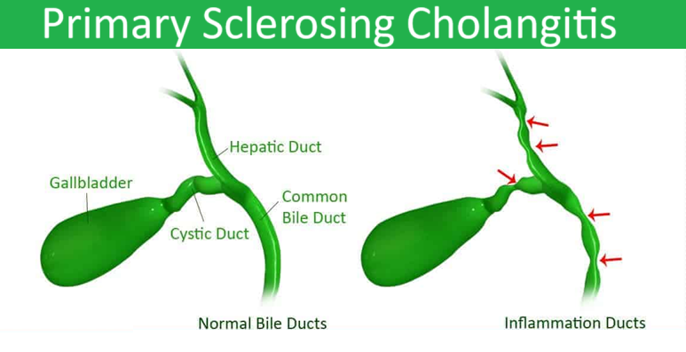 Primary Sclerosing Cholangitis in Gallblader in India